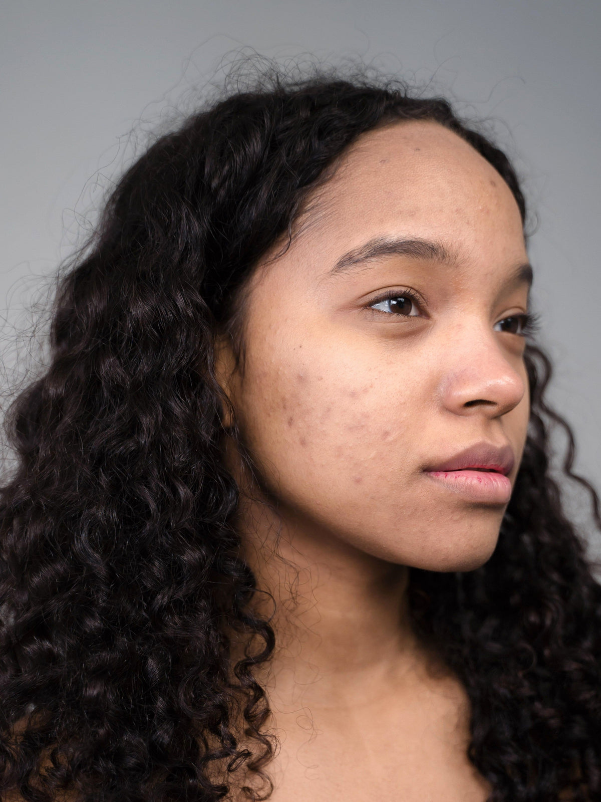 What Ingredients Actually Help Fade Acne Scars Over Time?